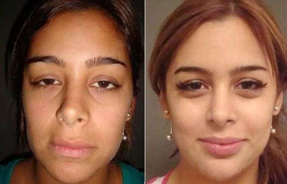 Clínica divulga fotos de Larissa Riquelme antes de plásticas - 