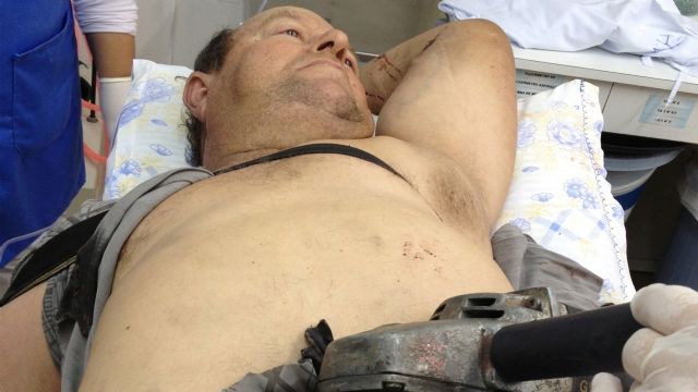 Passa bem agricultor que viajou 50 km com serra elétrica cravada na barriga no Sul - Steinmedc cortava lenha em casa, em Campina das Missões (RS), quando ocorreu o acidente. Divulgação / Hospital Vida & Saúde